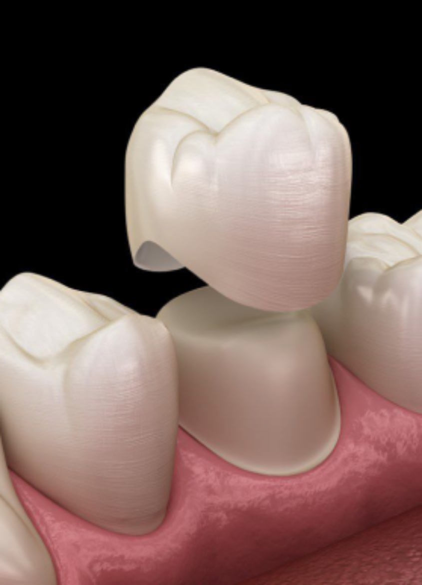 Picture of Dental Crowns