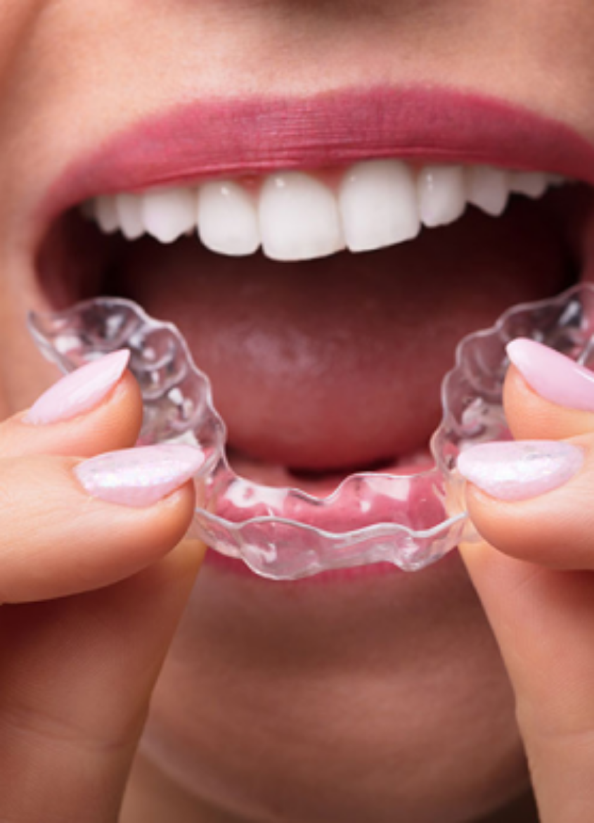 Picture of Orthodontic Treatment (Braces, Clear Aligners)