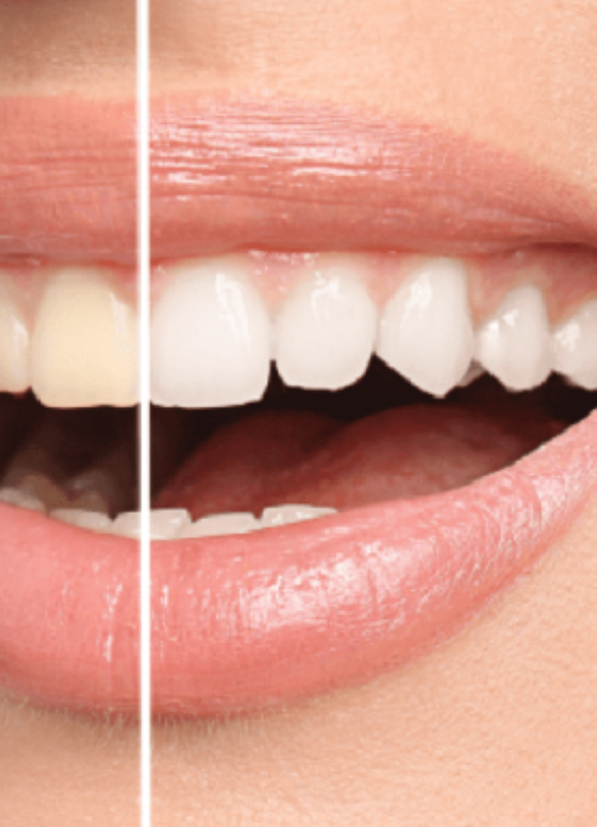 Picture of Teeth Whitening