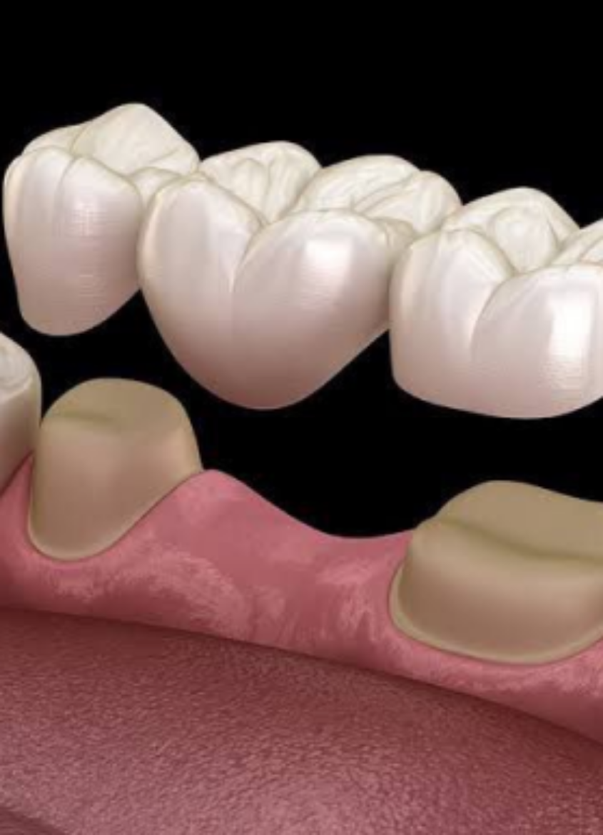 Picture of Dental Bridges