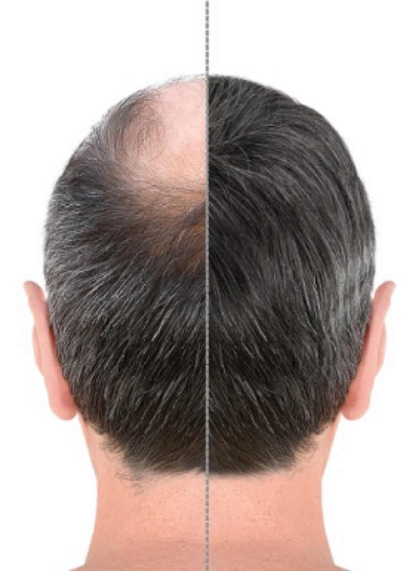 Picture of Hair Transplantation